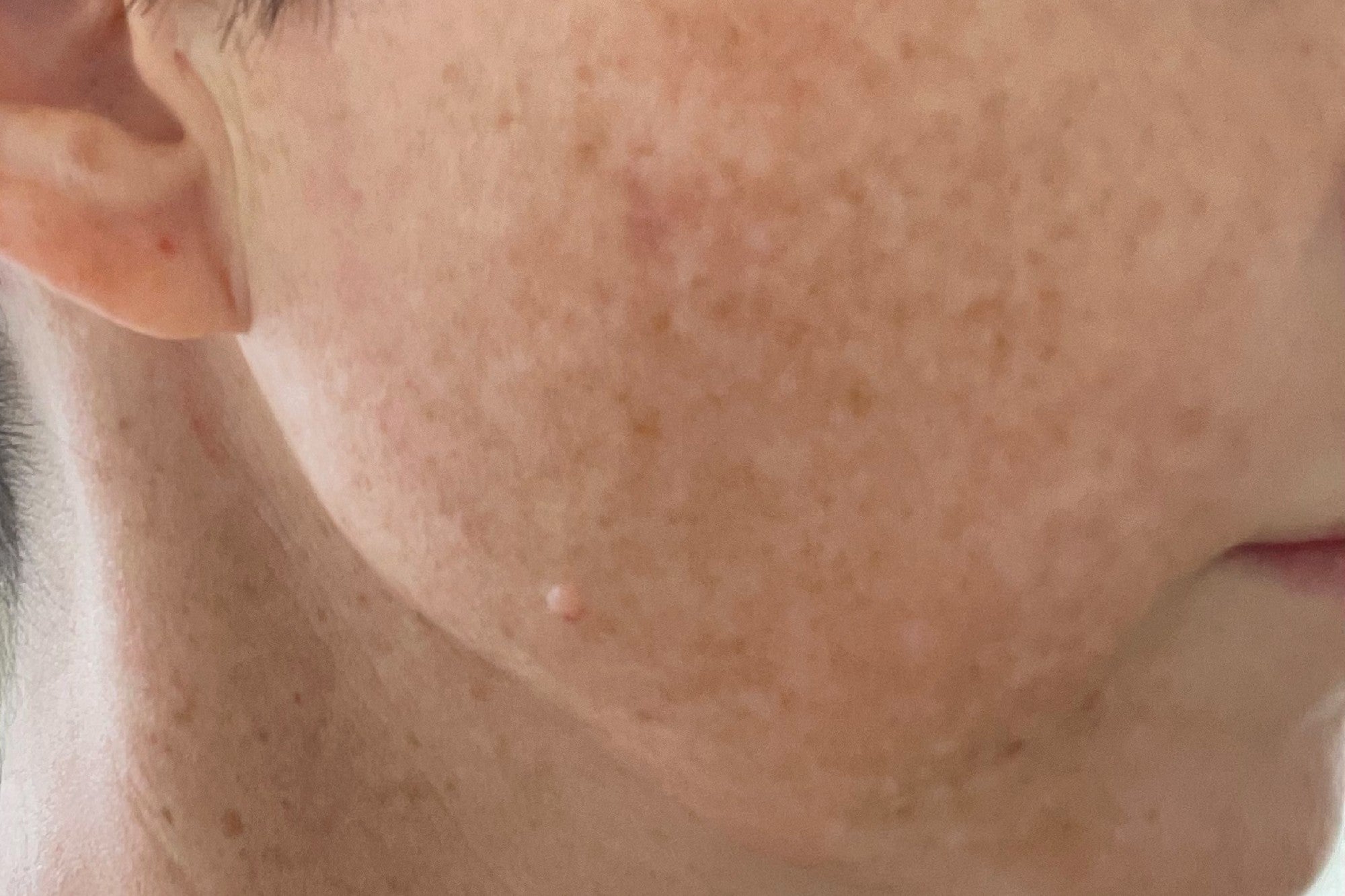 NEOVA Serious Clarity 4X – before: Close-up of cheek showing uneven skin texture, dullness, and lack of clarity prior to use of product.