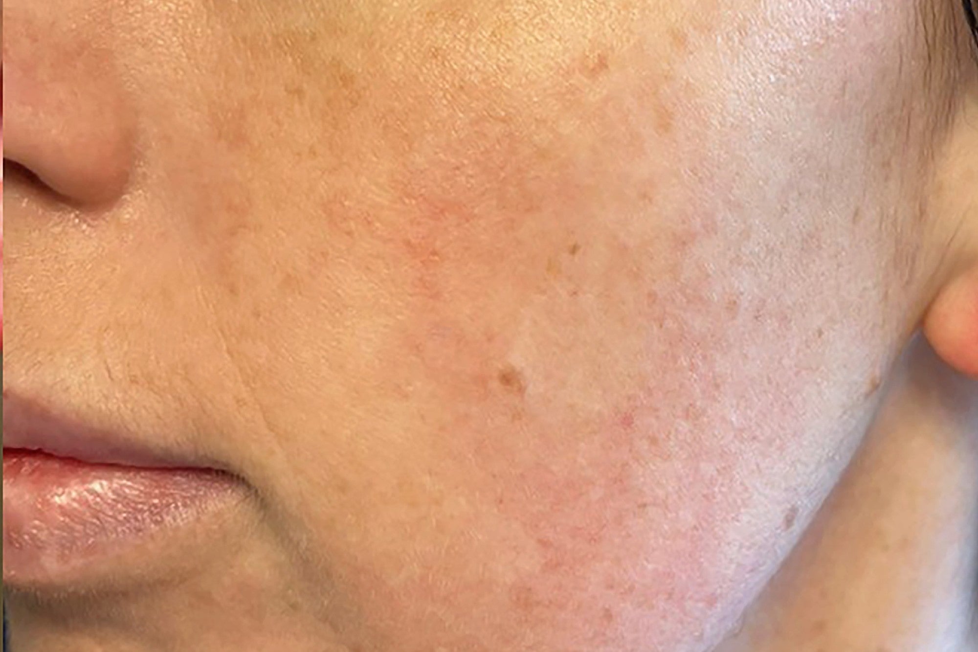 NEOVA Ultimate Redness Relief – after: Close-up of cheek showing reduced redness and calmer-looking skin with improved tone following use of product.