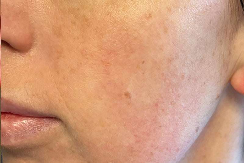 NEOVA Ultimate Redness Relief – after: Close-up of cheek showing reduced redness and calmer-looking skin with improved tone following use of product.