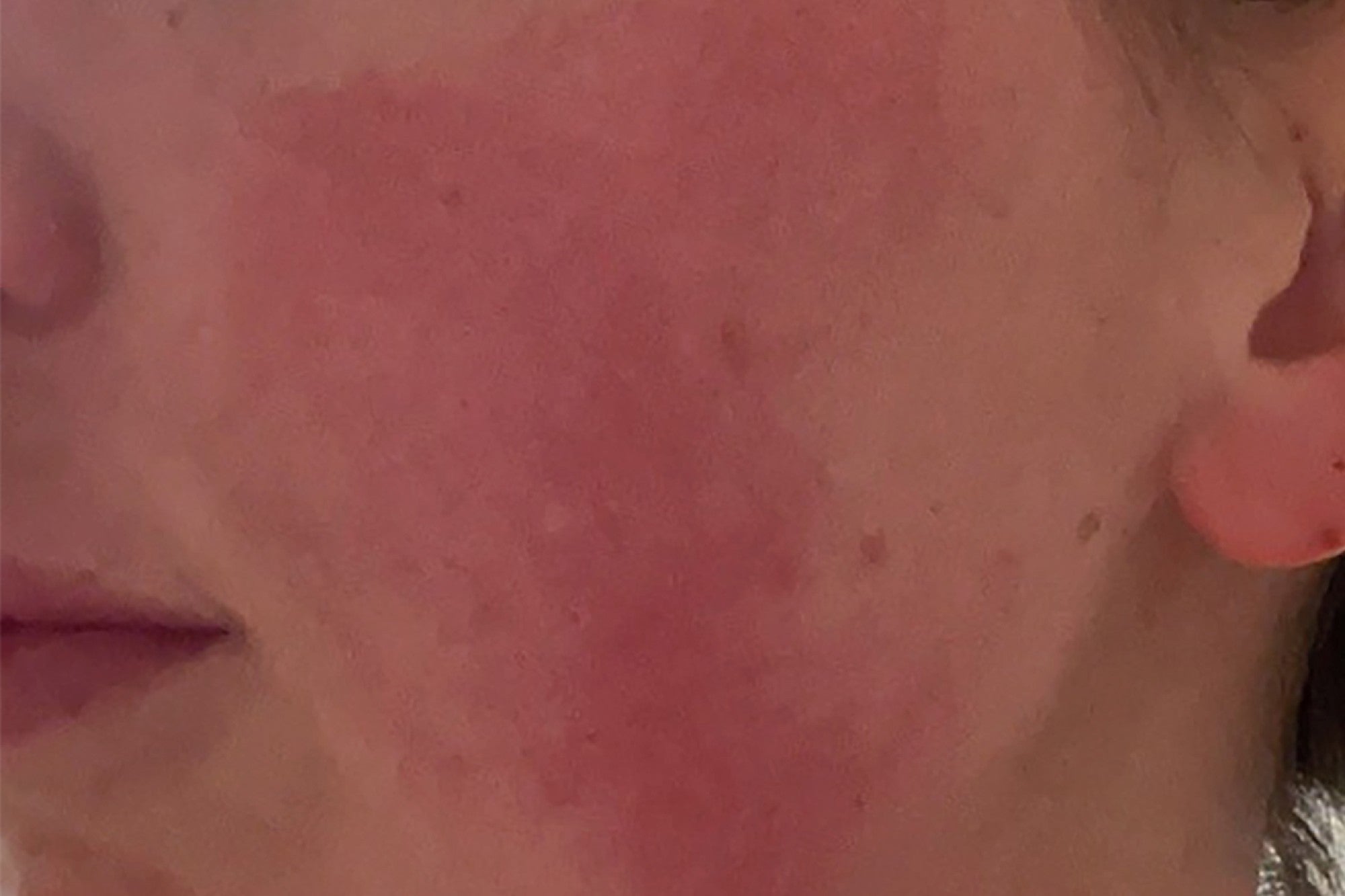 NEOVA Ultimate Redness Relief – before: Close-up of cheek showing significant redness, irritation, and uneven skin tone prior to use of product.