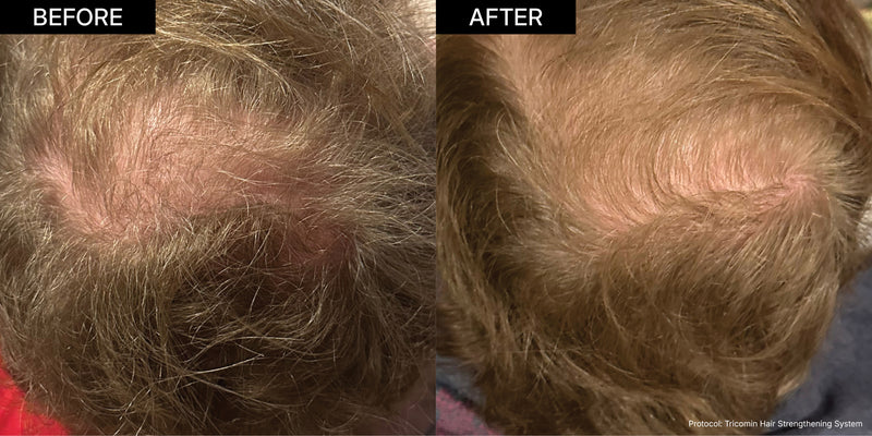 NEOVA Copper Peptides | A top-down before-and-after image demonstrating the Tricomin Hair Strengthening System's efficacy, which leverages NEOVA's signature copper peptide technology to reduce scalp visibility and increase hair density.